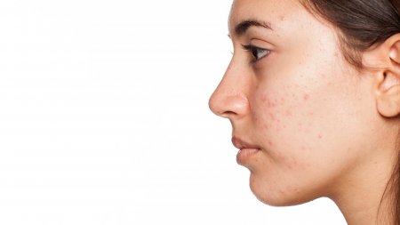 bioderma-pigmentbio_c-concentrate_kadın_post_inflamatuvar