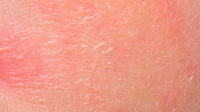 sedef hastaligi ve seboreik dermatite
