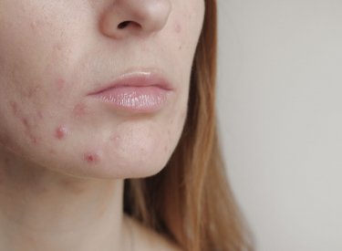 your-skin_sebium-sensitive_How-do-you-eliminate-acne