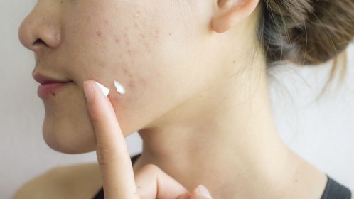 your-skin_sebium-sensitive_How-do-you-treat-acne-prone-skin